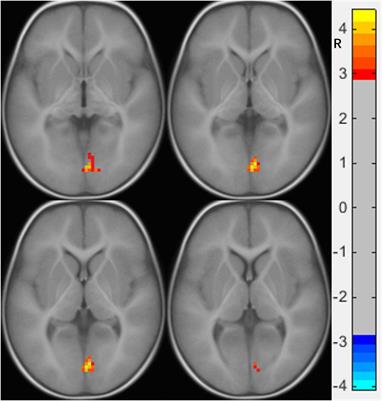 Functional Connectivity Underlying Symptoms in Preschool Boys With Autism: A Resting-State Functional Magnetic Resonance Imaging Study